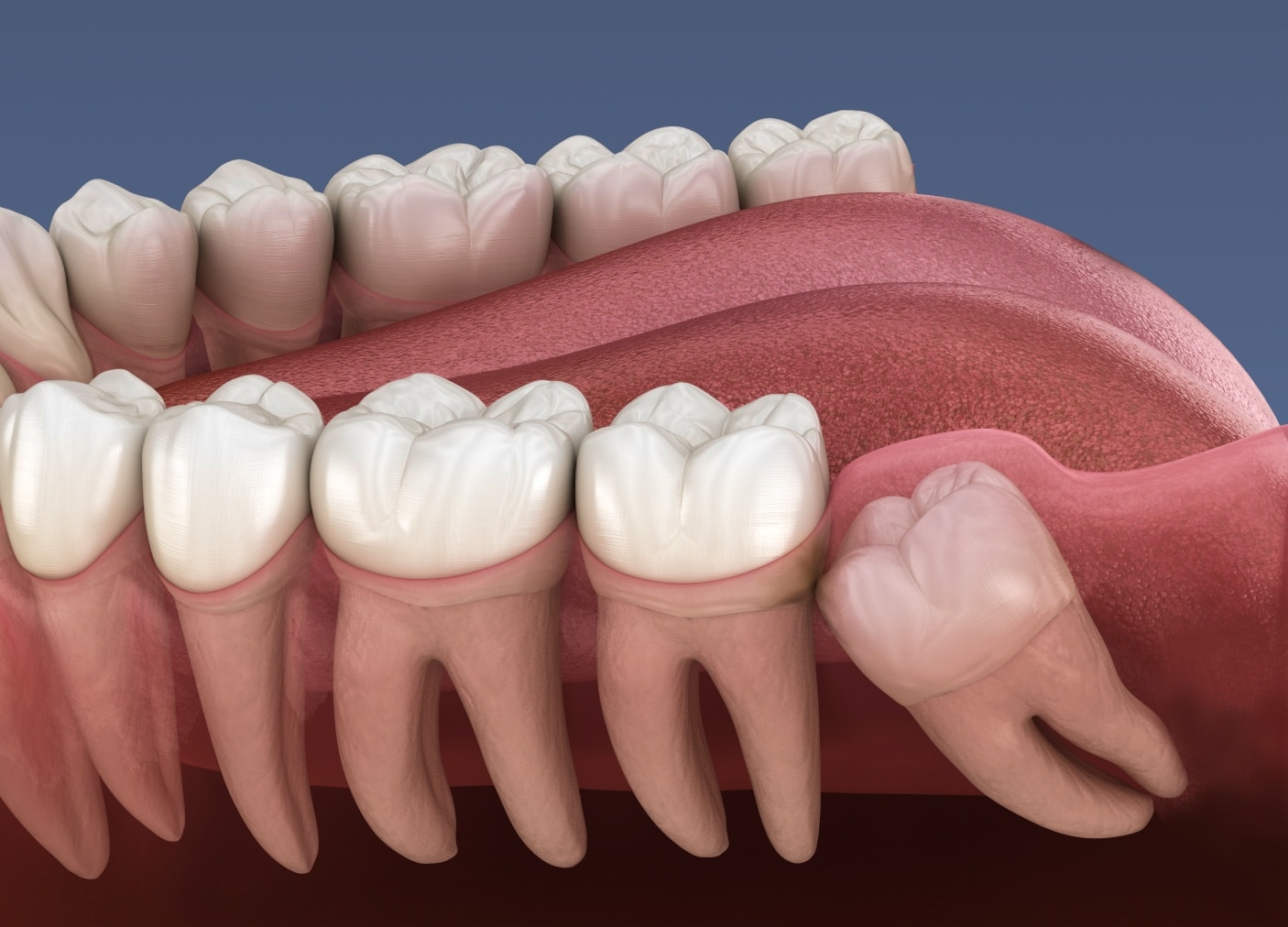 Extraction de dents de sagesse à Asnières sur Seine | Extraire dents de sagesse | Monsenego & Fils