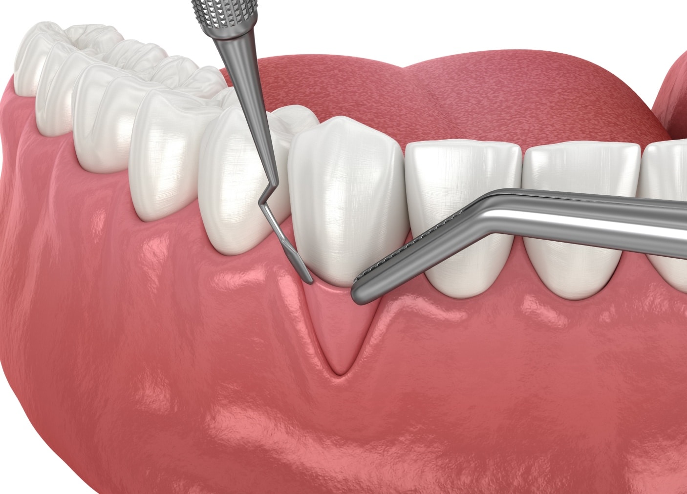 Greffe gingivale à Asnières sur Seine | Greffe de gencives douleur | Cabinet Monsenego & Fils