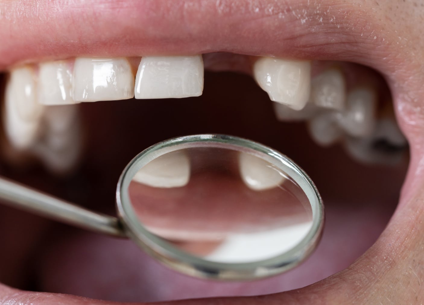 J'a perdu une dent : les solutions | Monsenego & Fils | Parodontite perte de dents | Asnières sur Seine