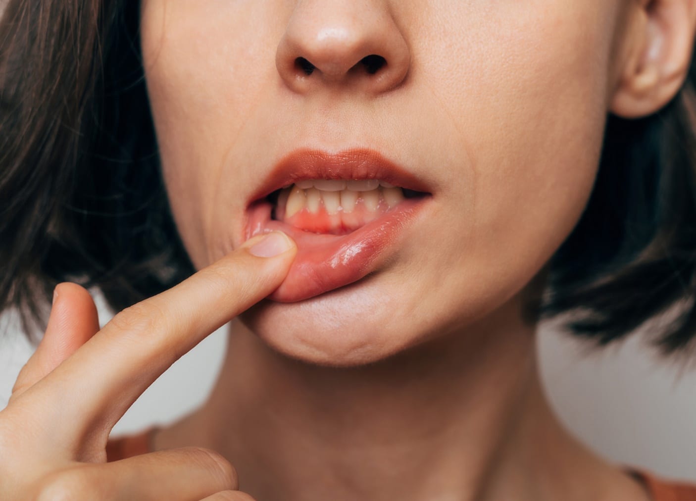 Parodontite : causes et traitements | Monsenego & Fils | Traitement parodontite | Asnières sur Seine