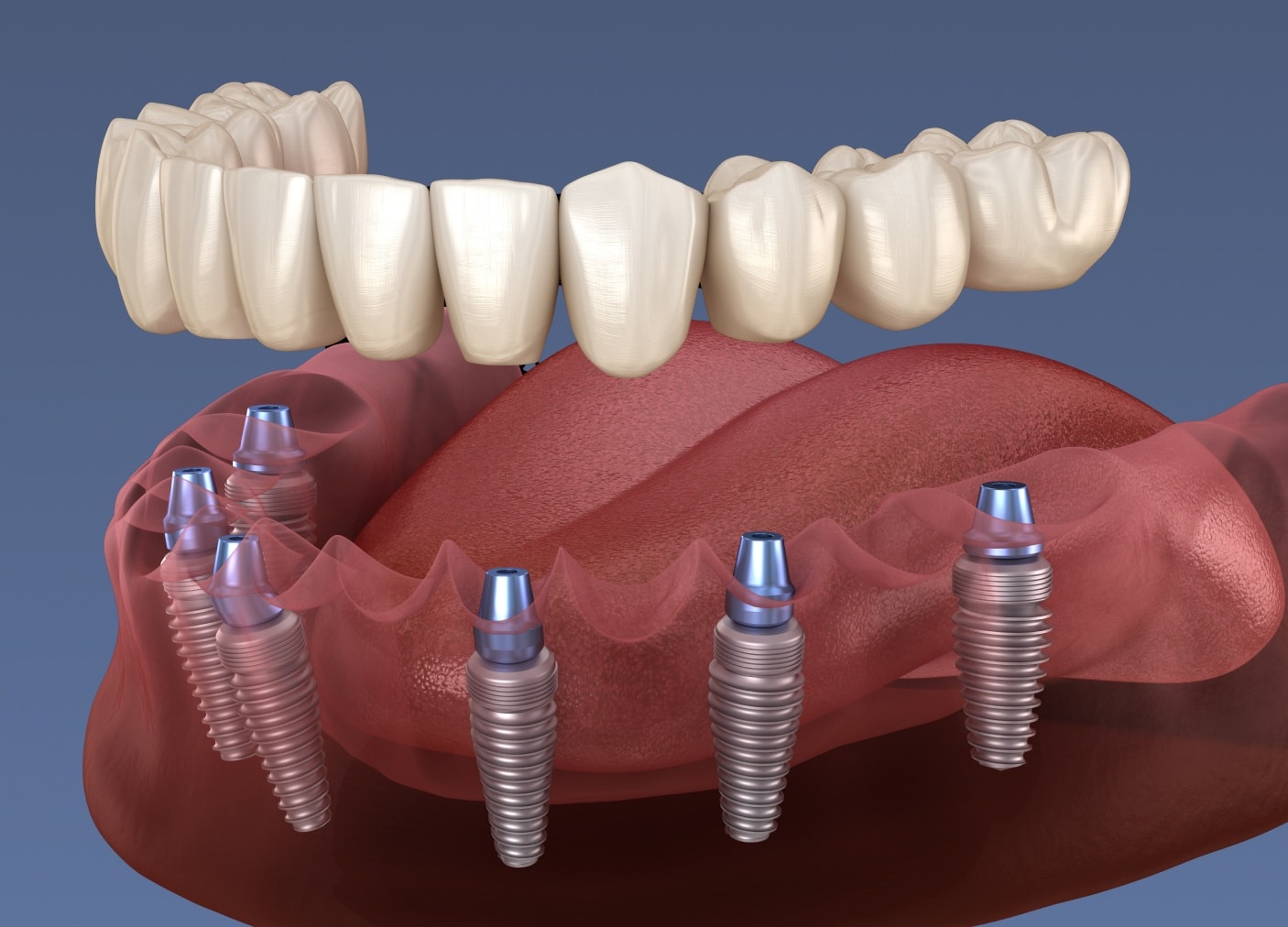 Prothèse sur implant à Asnières sur Seine | Prothèse dentaire sur implant | Cabinet Monsenego & Fils