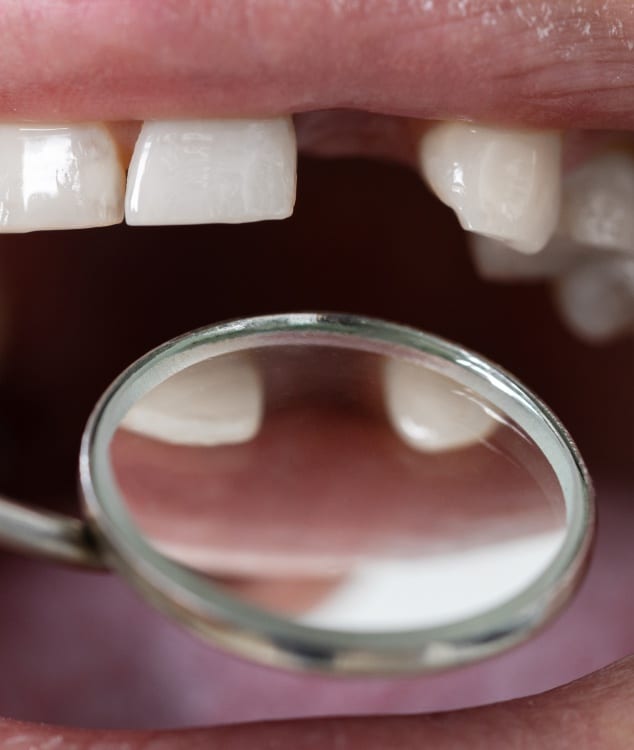 Vue rapprochee sur une bouche avec une dents perdue j ai perdue une dent | Dr Monsenego & Fils Asnieres sur Seine