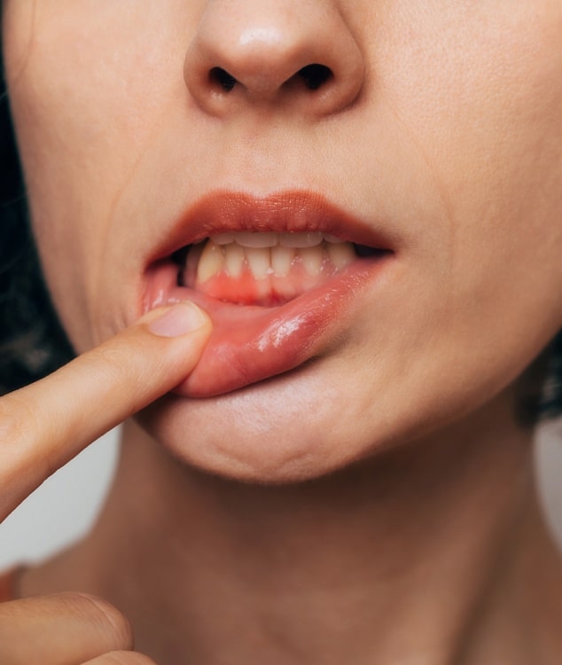 Photo rapprochee sur la bouche d une jeune femme montrant ses dents parodontite | Dr Monsenego & Fils Asnieres sur Seine