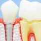 Implants dentaires VS bridges et dentiers : quels avantages ?