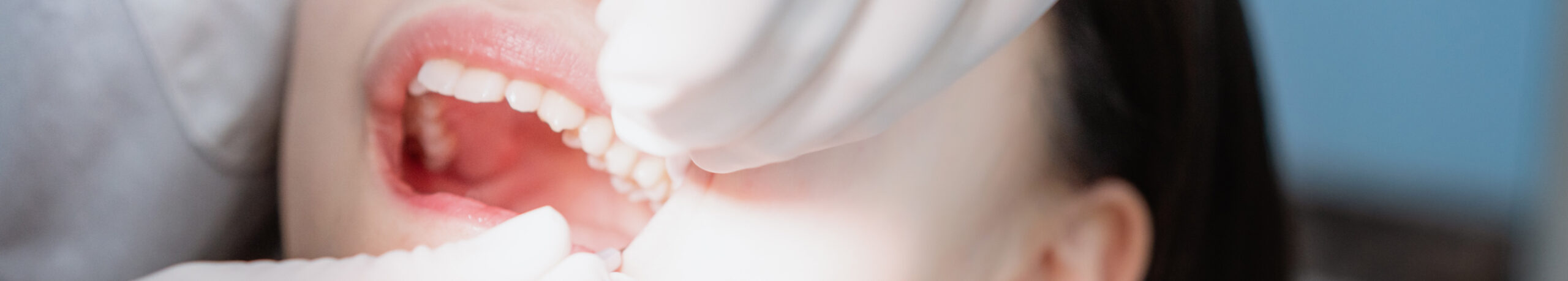 Extraction dents de sagesse