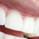 Combien de temps entre l’extraction et la pose d’un implant ?